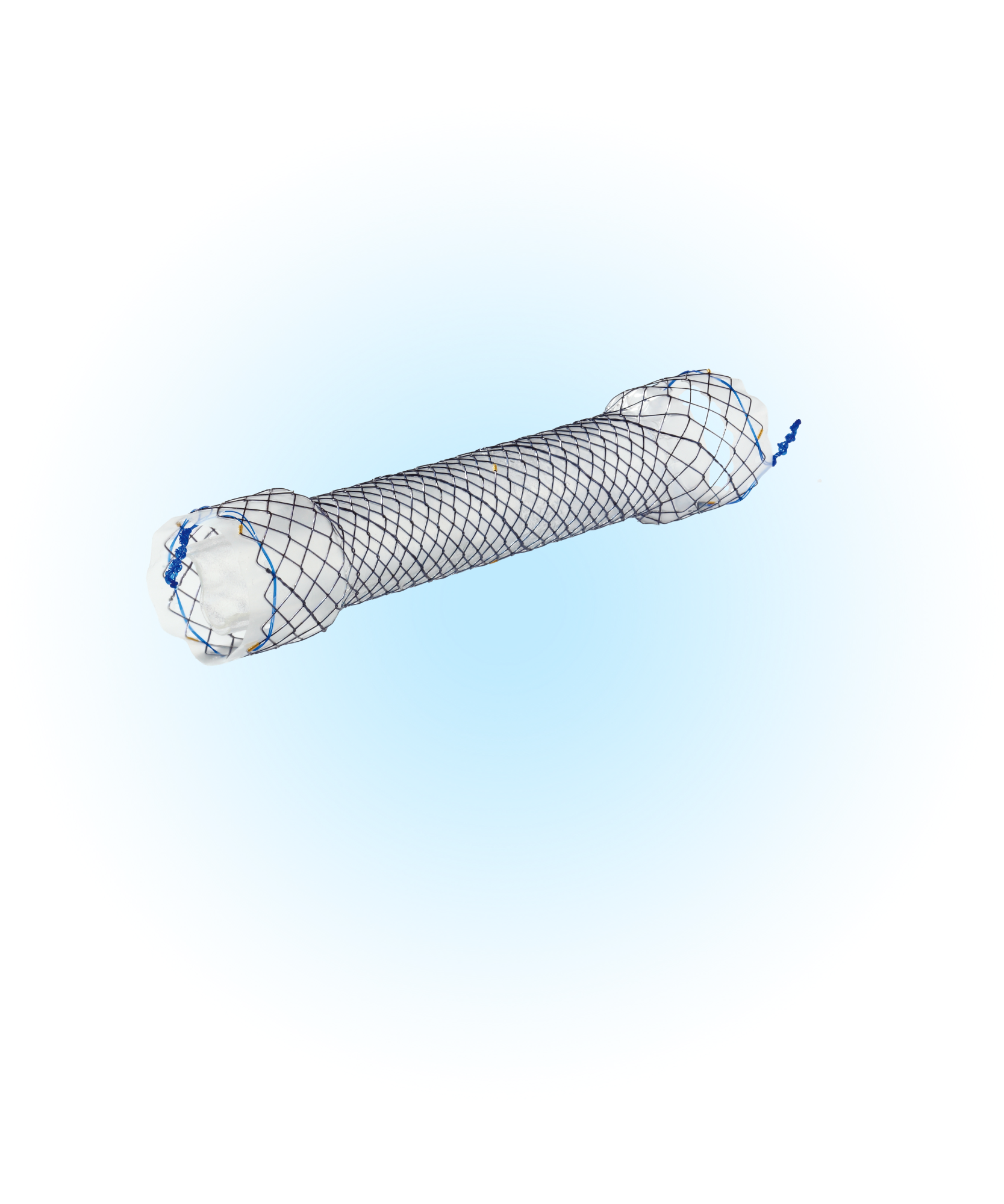EPC Özefagus Yarı Kaplı Anti-Reflü Valfli Stent