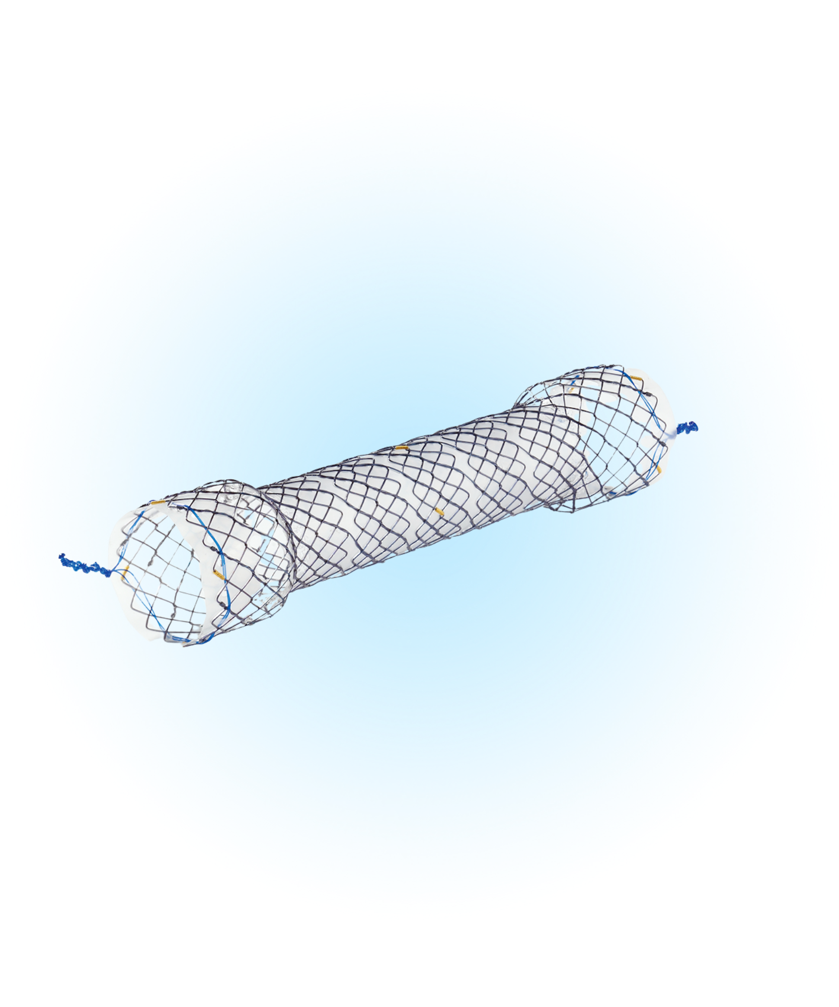 EPE Özefagus Yarı Kaplı Peristaltik Uyumlu Stent
