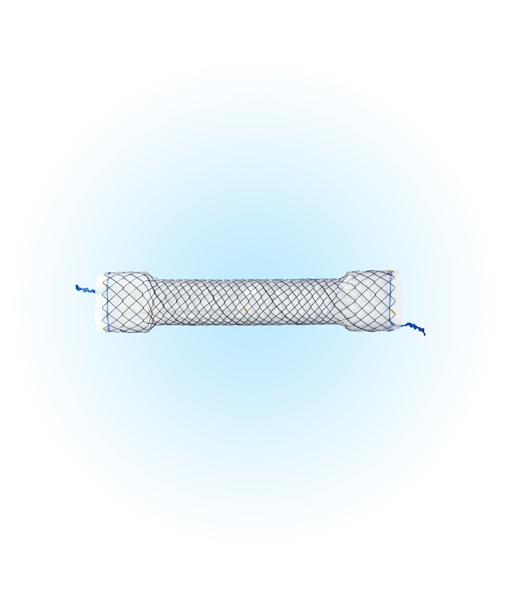HESV Özefagus Kaplı Anti-Reflü Valfli Stent